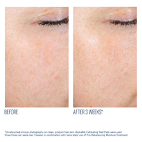 AlphaRet Exfoliating Peel Pads